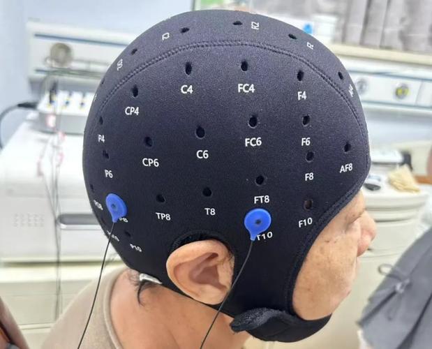 脑机接口治疗精神疾病（脑机接口治疗精神疾病需要多久）