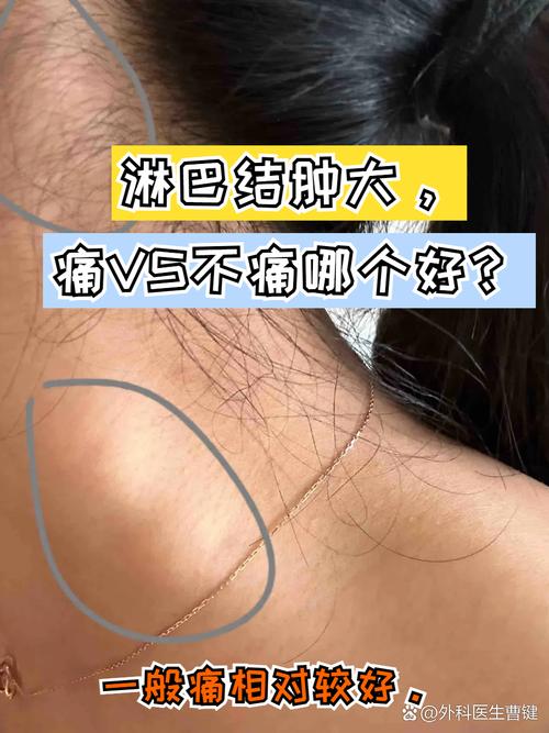 组织细胞坏死性淋巴结炎(组织细胞坏死性淋巴结炎是什么病)